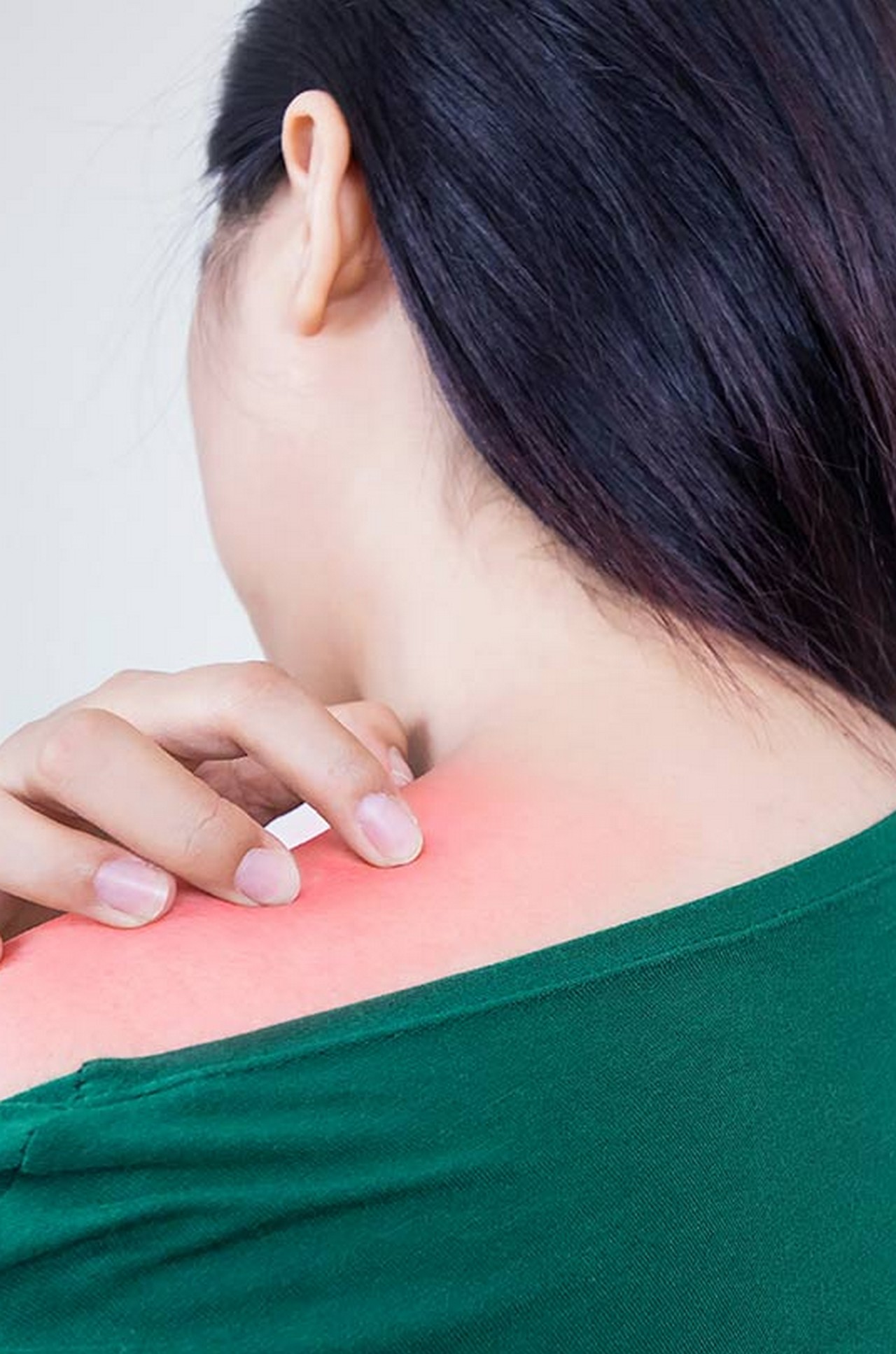  27 Home Remedies For Prickly Heat That Provide Quick Relief